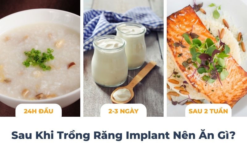Sau Khi Trồng Răng Implant Nên Ăn Gì