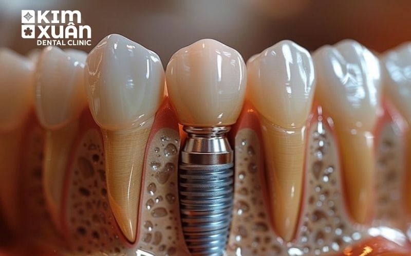 Sau Khi trồng Răng implant Nên Lưu Ý Gì