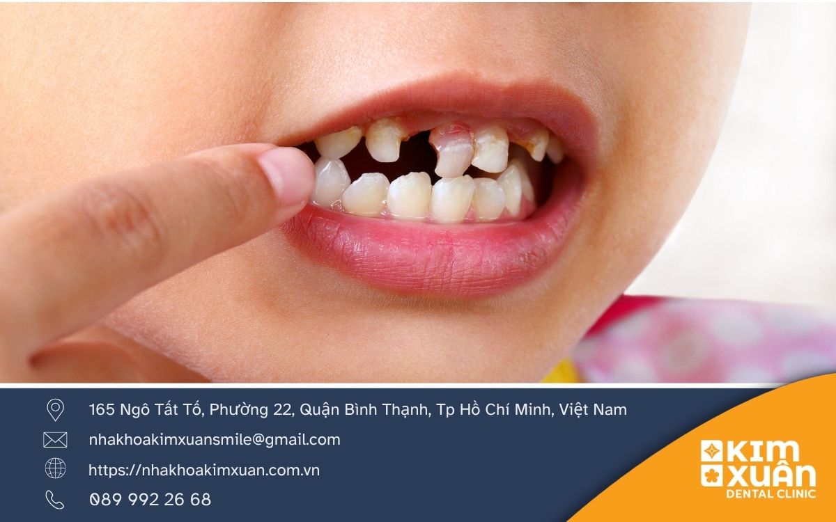 Sâu Răng Ở Trẻ Em Là Gì Nguyên Nhân Dấu Hiệu
