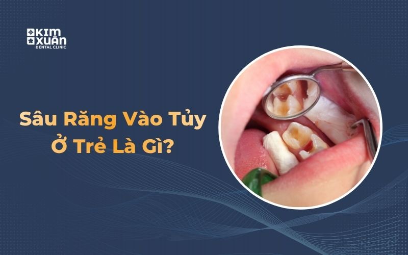 Sâu răng vào tủy ở trẻ em