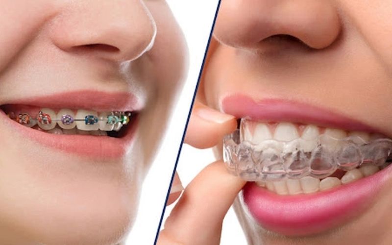 Niềng răng mắc cài kim loại và niềng răng trong suốt cho răng hô