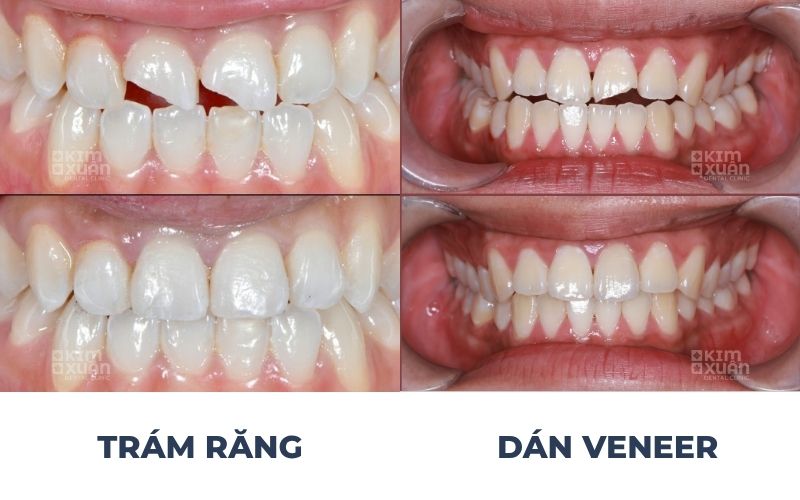 So Sánh Trám Răng Và Dán Sứ Veneer