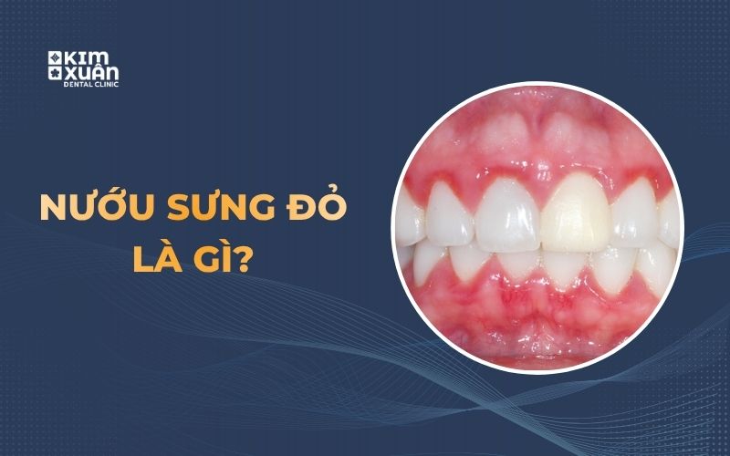 Sưng nướu răng