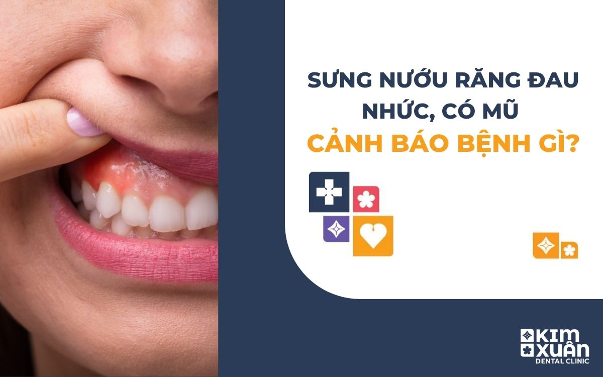 Sưng Nướu Răng Đau Nhức Cảnh Báo Bệnh Gì?