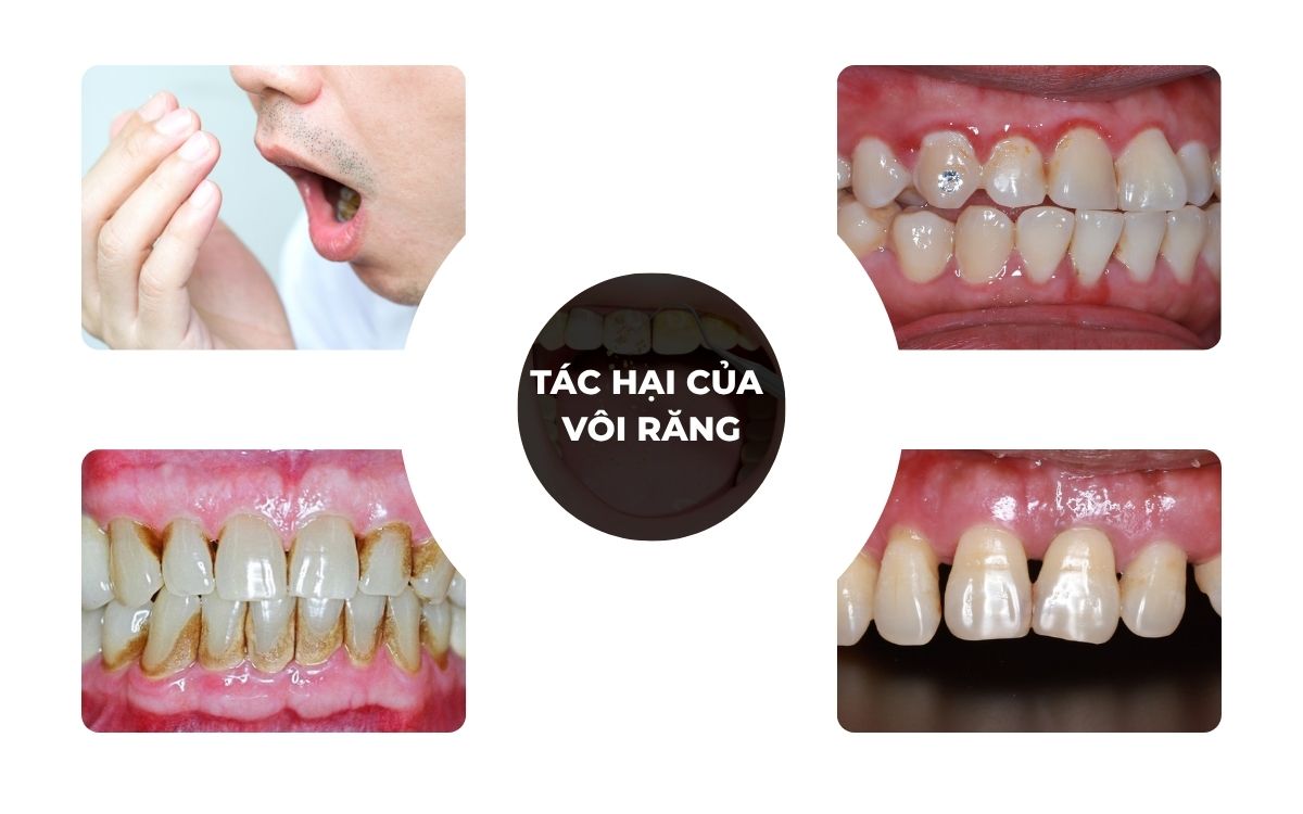 Tác Hại Của Vôi Răng