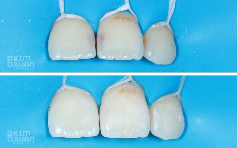 Tác Hại Khi Răng Cửa Bị Sâu