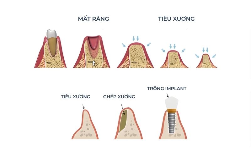 Tại Sao Phải Ghép Xương Khi Trồng Răng Implant