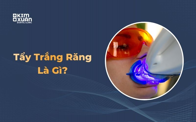 Tẩy trắng răng tại nha khoa