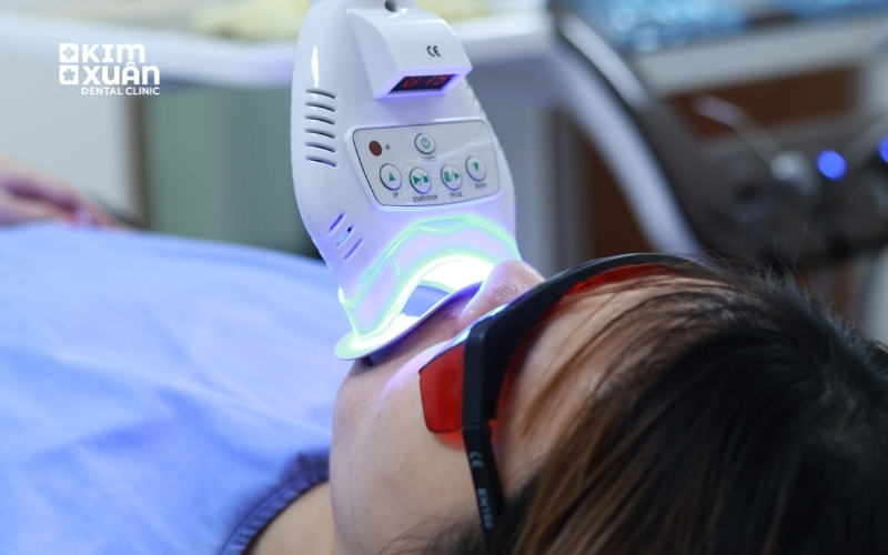 Tẩy Trắng Răng Bằng Đèn Led Tại Nha Khoa Kim Xuân