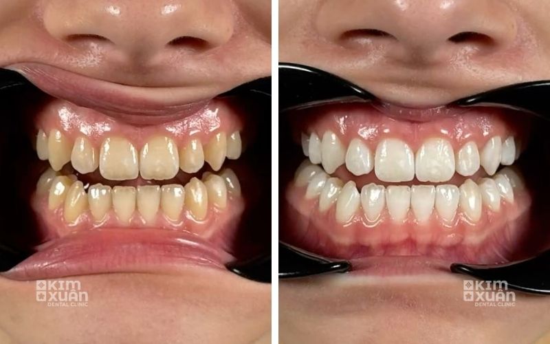Kết quả trước và sau khi tẩy trắng răng giúp răng sáng màu và đều màu hơn tại Nha khoa Kim Xuân