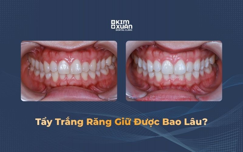 Hình ảnh kết quả tẩy trắng răng và thời gian duy trì màu răng