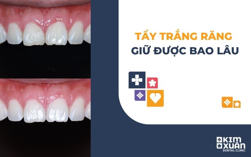 Tẩy Trắng Răng Giữ Được Bao Lâu