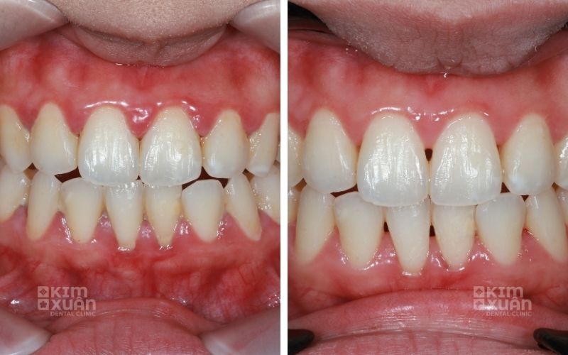 Tẩy Trắng Răng Nha Khoa Kim Xuân