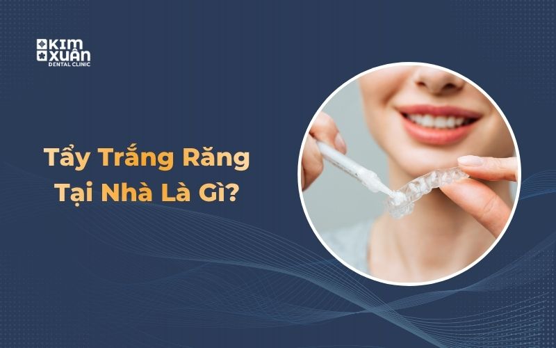 Phương pháp tẩy trắng răng tại nhà bằng máng tẩy
