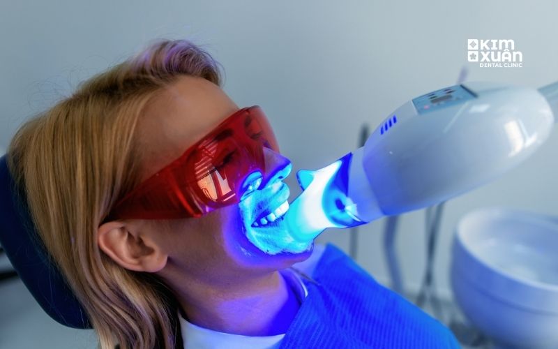 Tẩy Trắng Răng Tại Nha Khoa