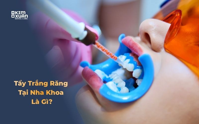 Phương pháp tẩy trắng răng tại nha khoa