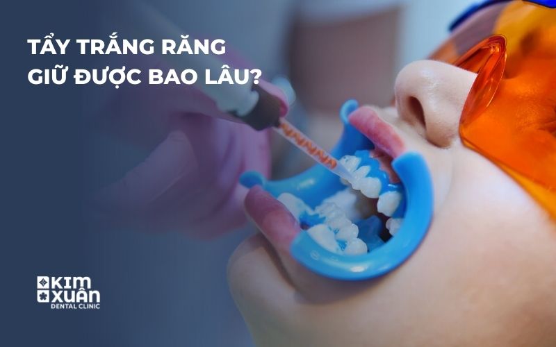 Tẩy Trắng Răng Tại Nha Khoa Kim Xuân
