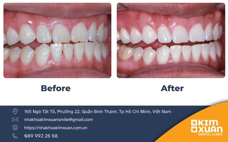 Tẩy Trắng Răng Tại Nha Khoa Kim Xuân