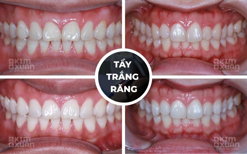 Tẩy Trắng Răng Tại Nha Khoa Kim Xuân