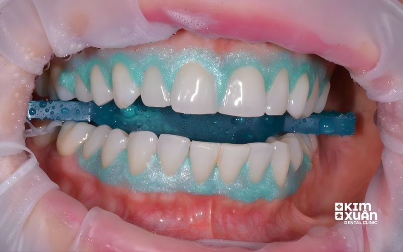 Hình ảnh tẩy trắng răng tại phòng nha với gel chuyên dụng và đèn hỗ trợ tại Nha khoa Kim Xuân