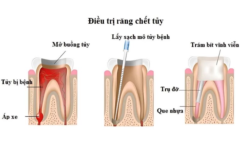 Thời Gian Lấy Tủy Răng Mất Bao Lâu