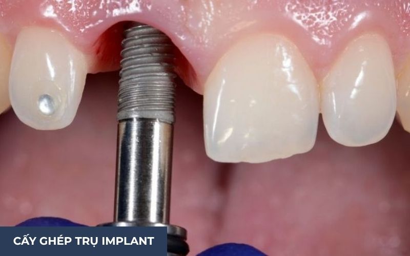 Tiến Hành Phẩu Thuật Trồng Răng Implant