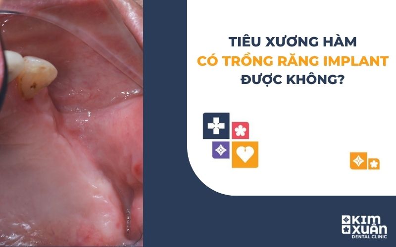 Tiêu Xương Hàm Có Trồng Răng Implant Được Không