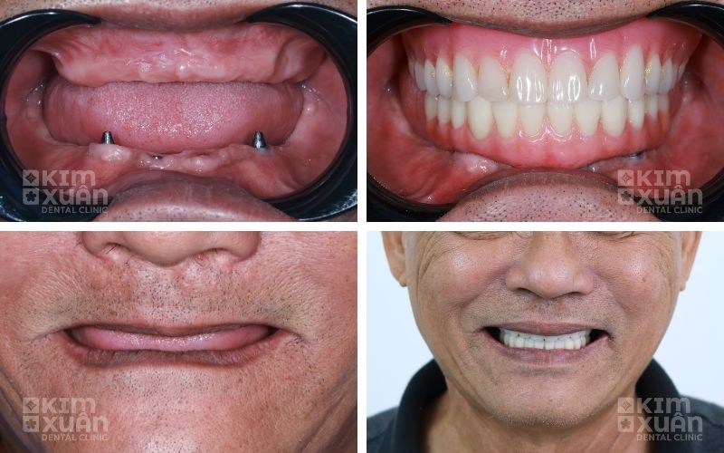 Tiêu Xương Hàm Có Trồng Răng Được Không Ảnh Trước Và Sau Khi Trồng Răng