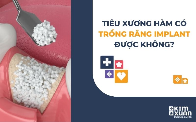 Tiêu Xương Hàm Có Trồng Răng Được Không