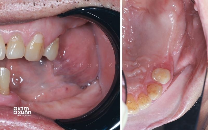 Tiêu Xương Hàm Dấu Hiệu Nhận Biết