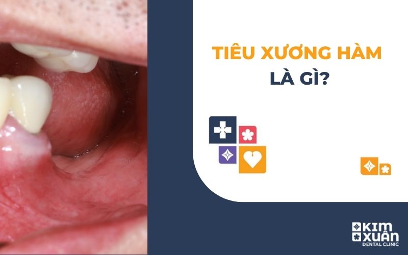 Tiêu Xương Hàm Là Gì