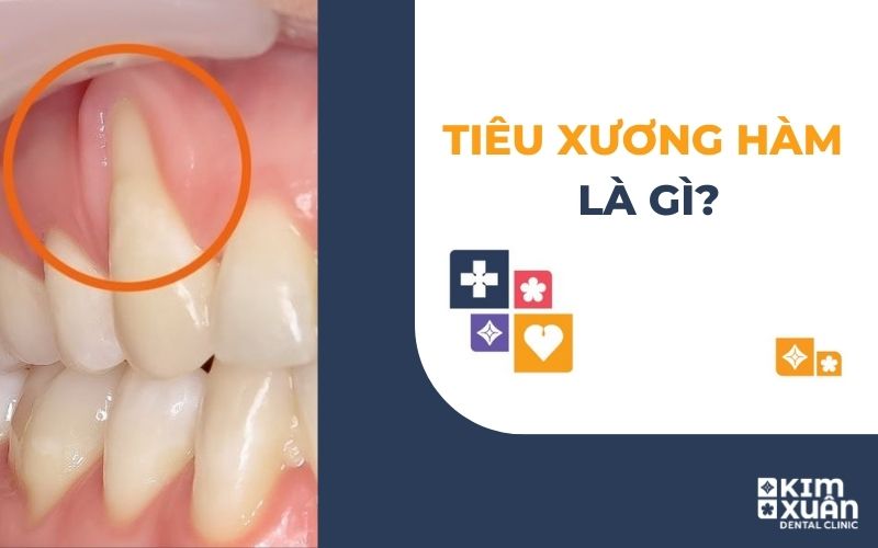 Tiêu Xương Hàm Là Gì?