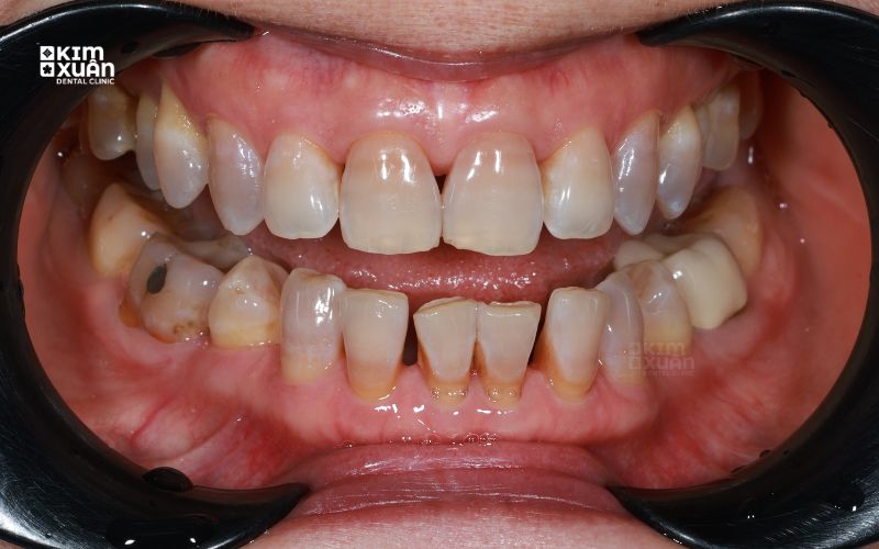 Trám mòn cổ chân răng có hiệu quả không