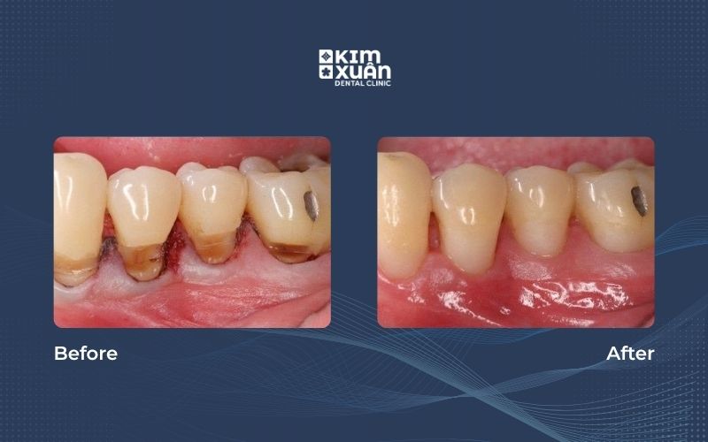 Trám mòn cổ chân răng tại nha khoa Kim Xuân