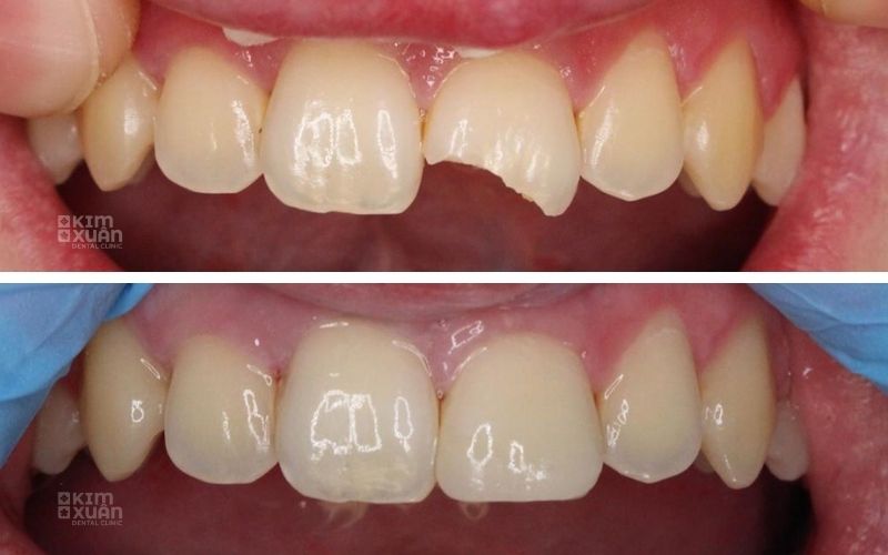 Trám Răng Bị Mẻ Bao Nhiêu Tiền