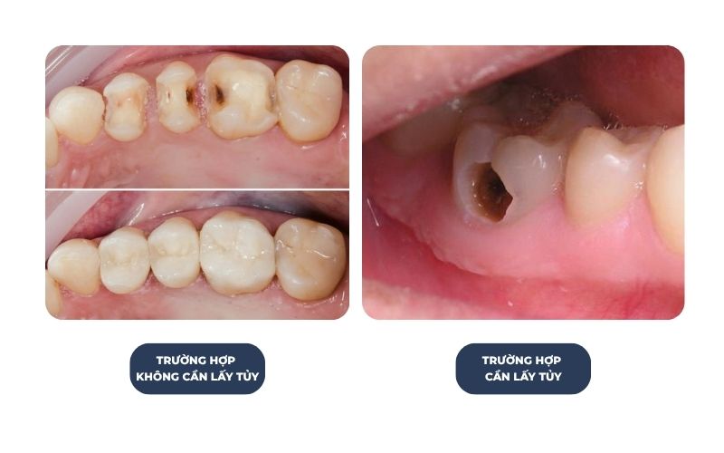 Trám Răng Có Cần Lấy Tủy Không?