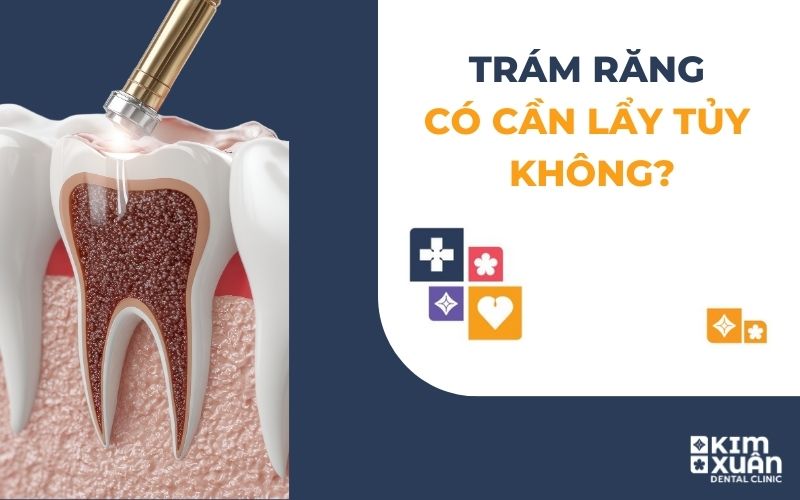 Trám Răng Có Cần Lấy Tủy Răng Không