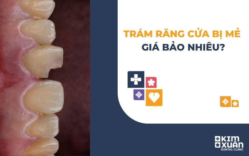 Trám Răng Cửa Bị Mẻ Giá Bao Nhiêu