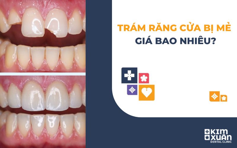 Trám Răng Cửa Bị Mẻ Giá Bao Nhiêu Tiền