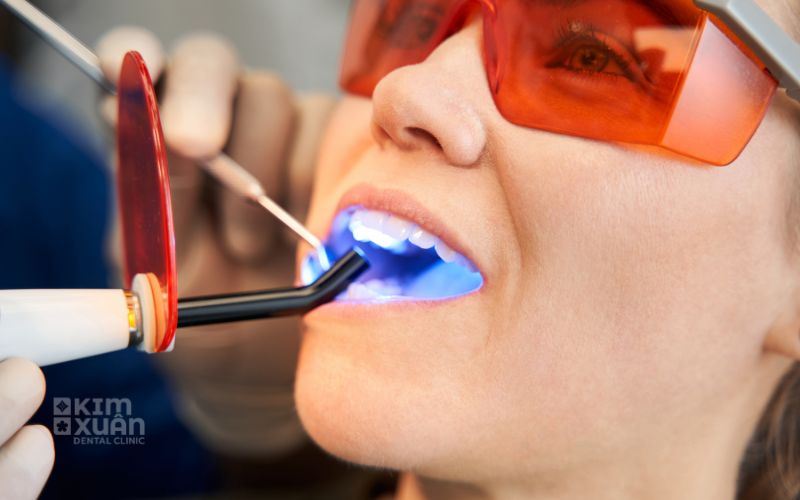 Trám Răng Cửa Bị Sâu Có Bền Không