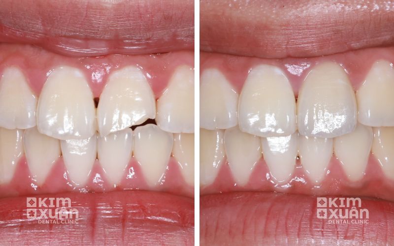 Trám Răng Cửa Giá Bao Nhiêu Tại TP. HCM