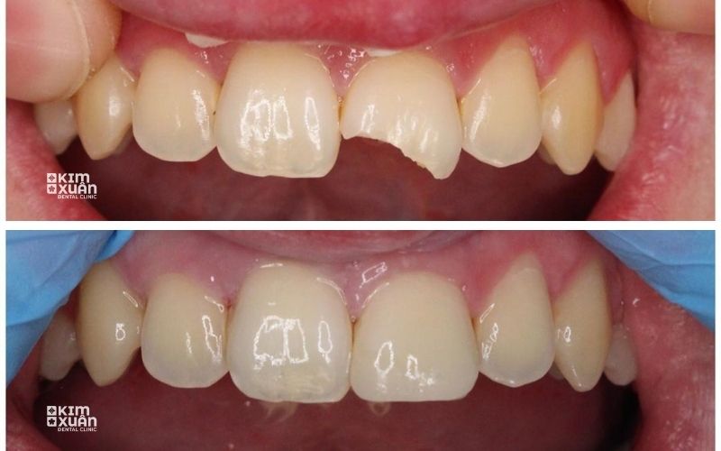 Trám Răng Cửa Bị Mẻ