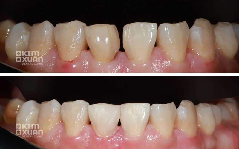 Trám Răng (Hàn) Răng Mẻ Có Bền Không