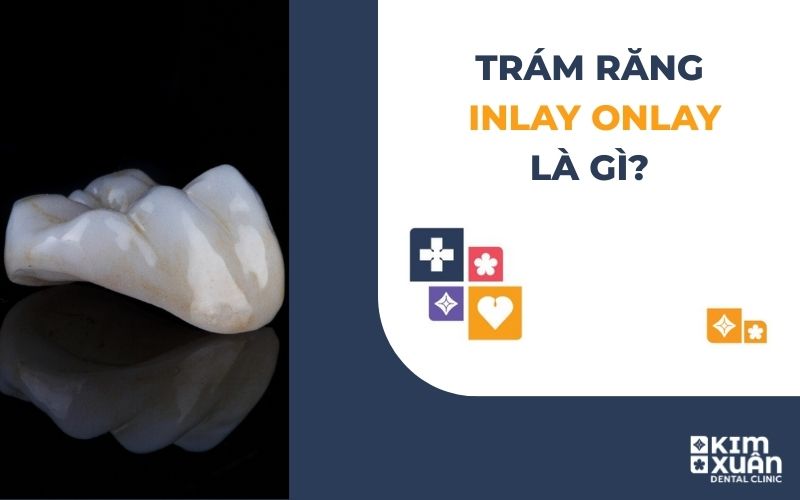 Trám Răng Inlay/Onlay