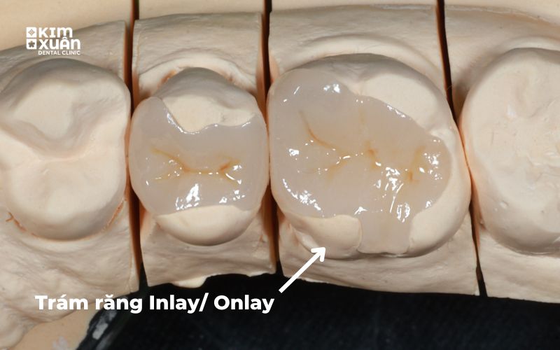 Trám Răng Inlay Onlay