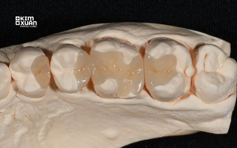 Trám Răng Inlay/Onlay Có Tốt Không