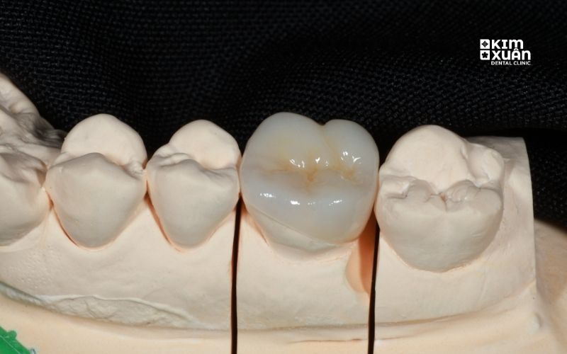 Trám Răng Inaly/Onlay Bao Nhiêu Tiền