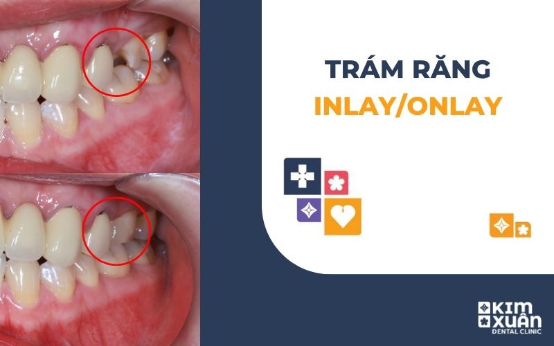 Trám Răng Inlay/Onlay Là Gì