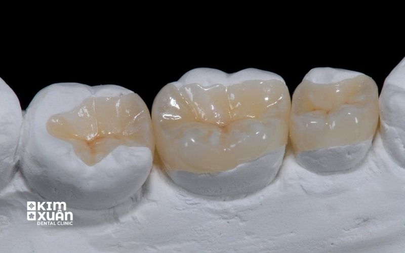 Trám Răng Inlay/Onlay Tại Nha Khoa Kim Xuân TP.HCM