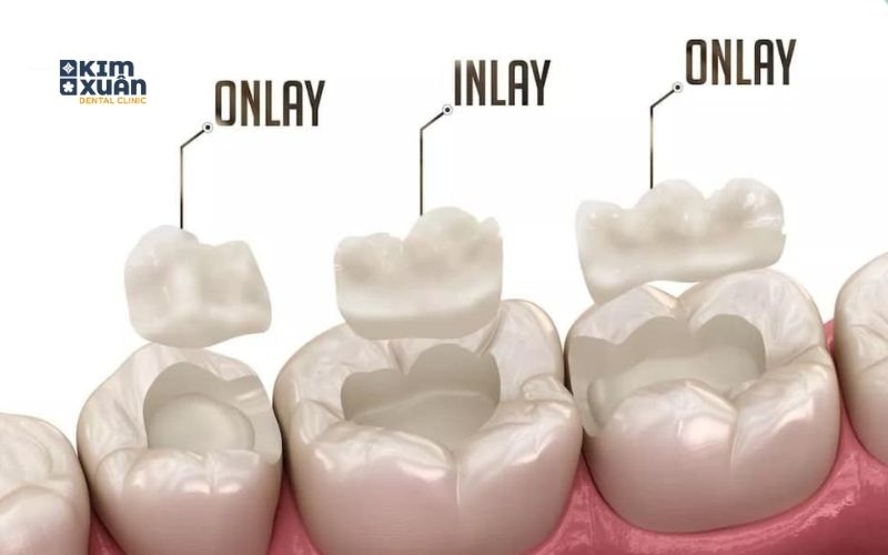 Trám Răng Inlay/Onlay Ưu Điểm Nhược Điểm
